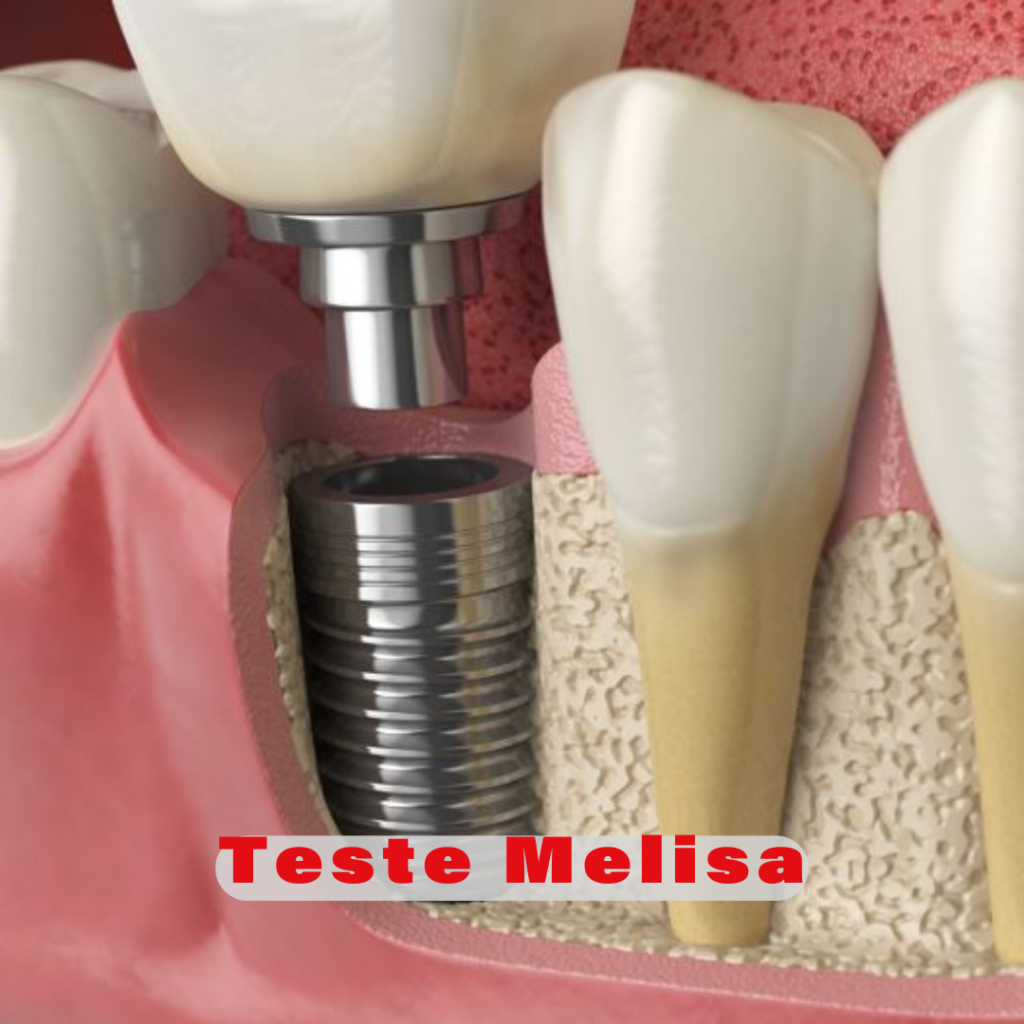 Alergia a Metais teste melisa hipersensibilidade