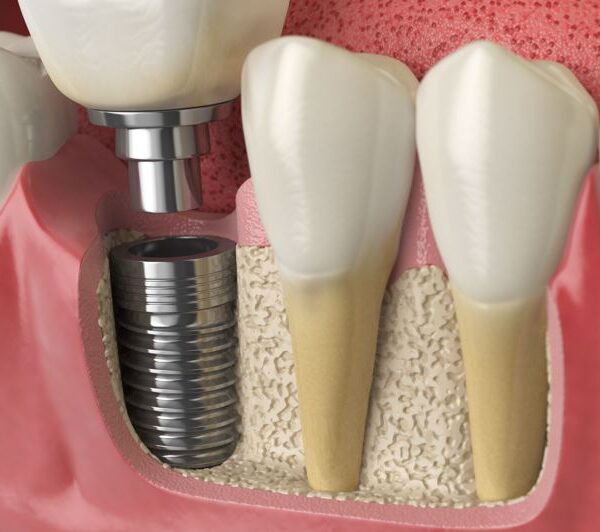 Alergia a Metais teste melisa